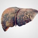 Liver disease cirrhosis can be a disabling condition