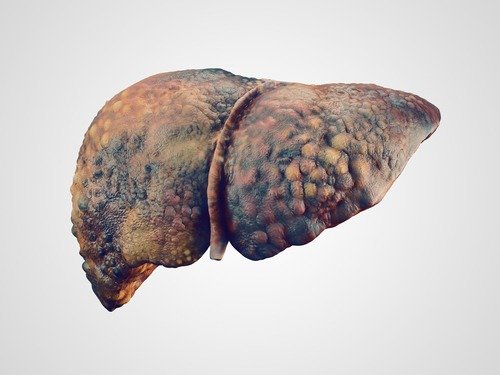 Liver disease cirrhosis can be a disabling condition