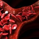 Disabling blood disease Sickle cell anemia