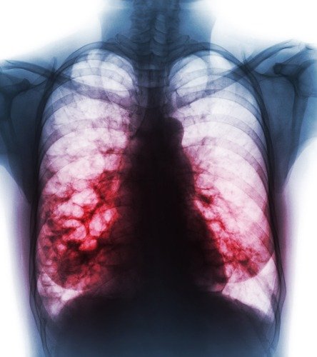 Get Disability for Bronchiectasis
